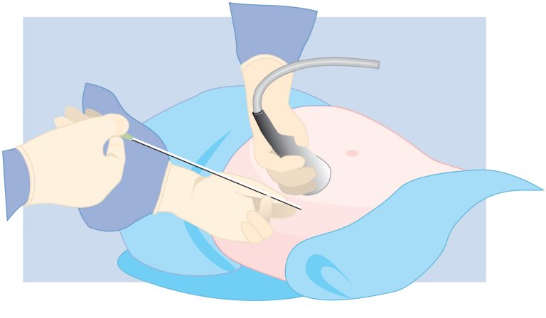 Abdominal Egg Retrieval © CRGH