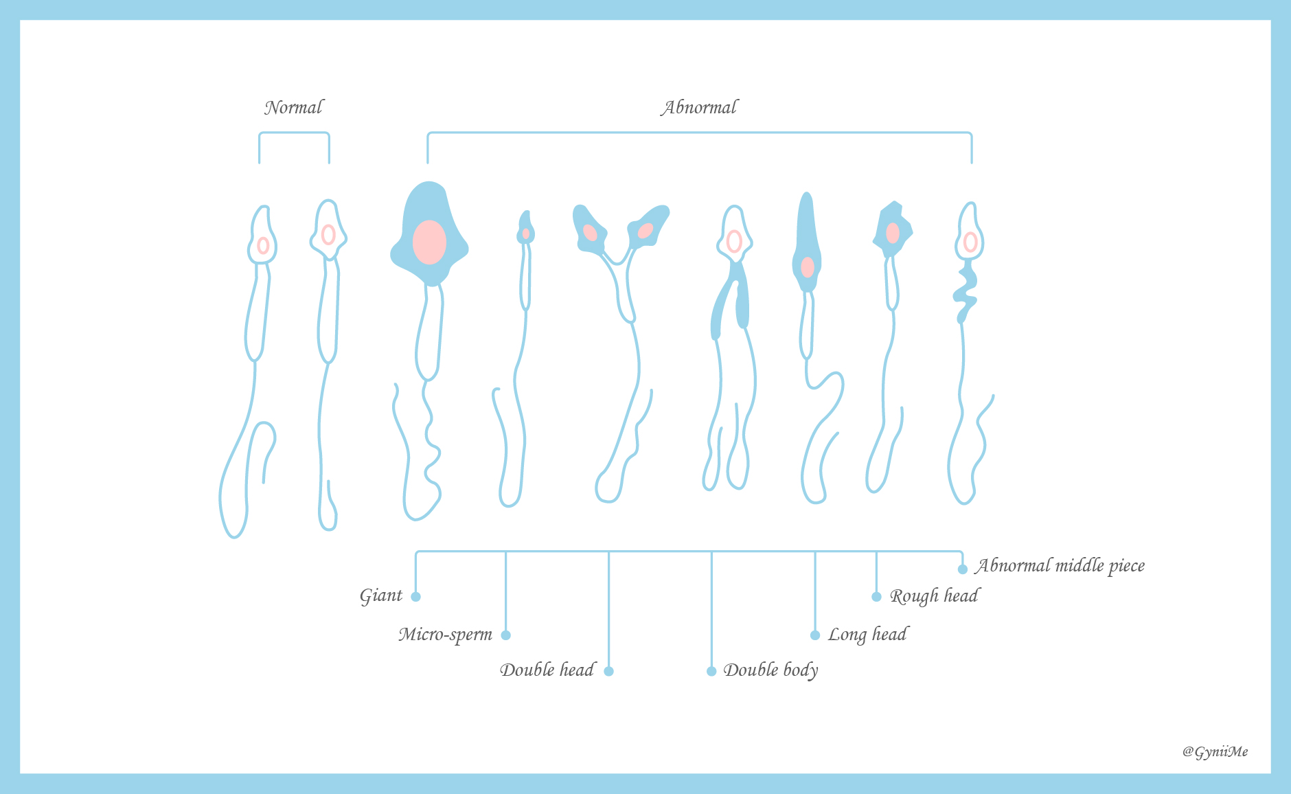 Diagram comparing normal and abnormal sperm morphology
